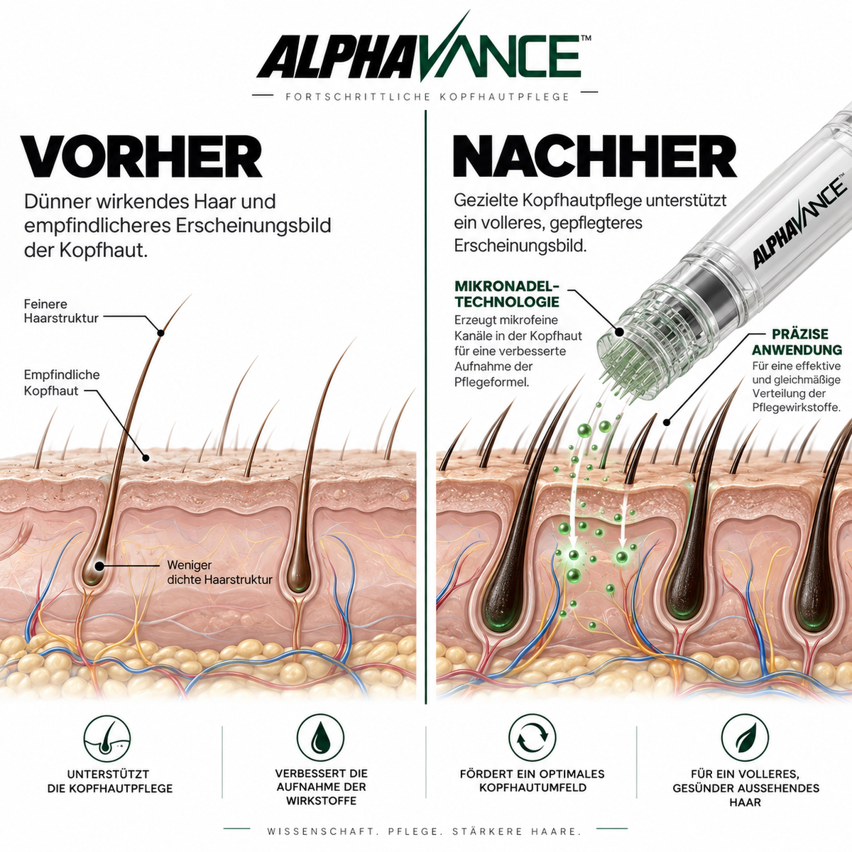 AlphaVance™ - System zur Haarwiederherstellung