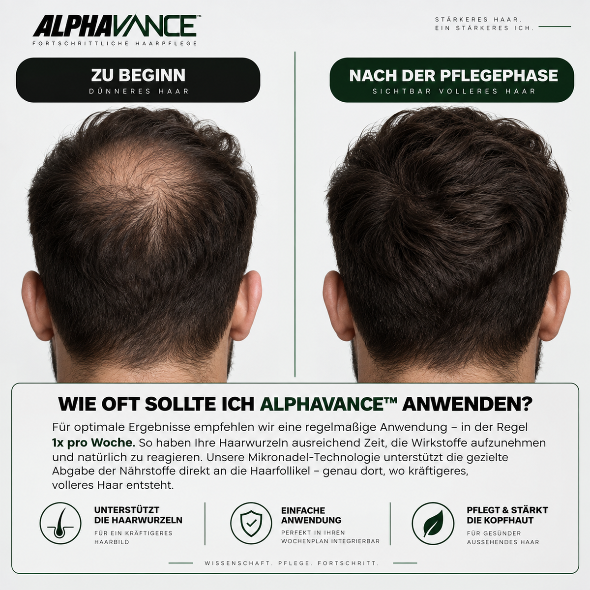 AlphaVance™ - System zur Haarwiederherstellung
